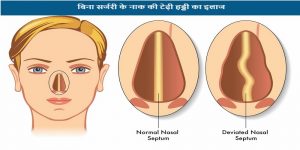 nak ki tedhi haddi ka ilaj