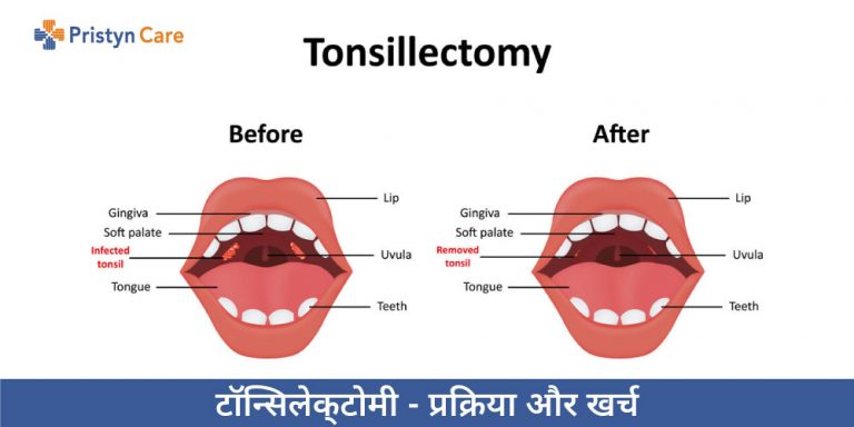 Tonsillectomy in Hindi