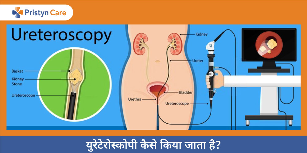 how-is-ureteroscopy-done-in-hindi
