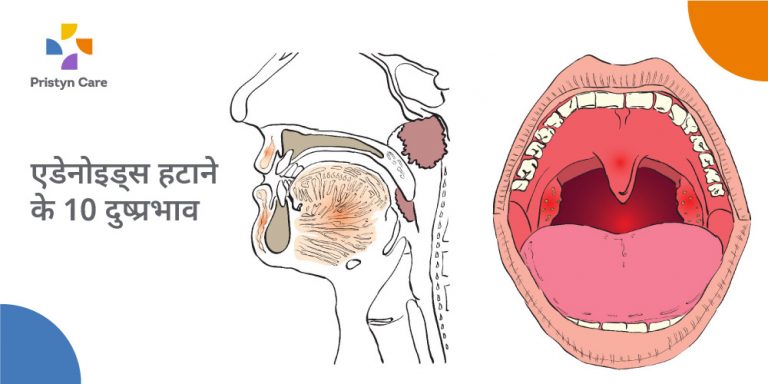 एडेनोइड्स हटाने के नुकसान