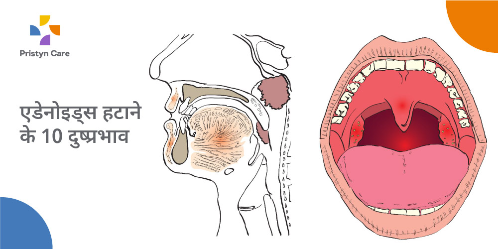 एडेनोइड्स हटाने के नुकसान