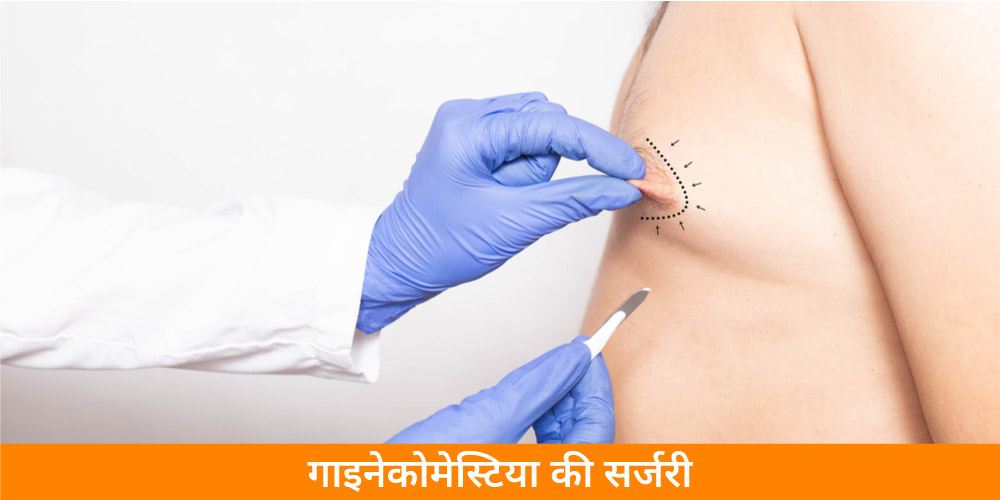 gynaecomastia-surgery-in-hindi
