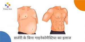 gynecomastia-treatment-without-surgery-in-hindi