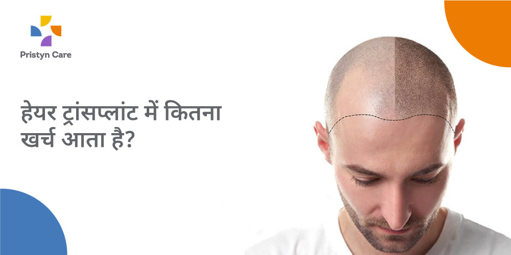 भारत में बाल प्रत्यारोपण (हेयर ट्रांसप्लांट) का खर्च भारत में बाल प्रत्यारोपण (हेयर ट्रांसप्लांट) का खर्च