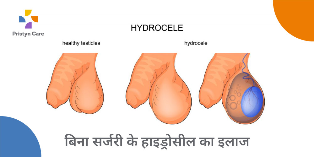 hydrocele-treatment-without-surgery-in-hindi