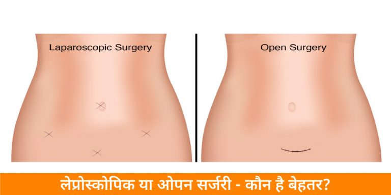 लेप्रोस्कोपिक या ओपन सर्जरी