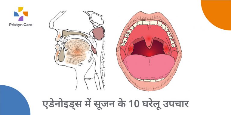 एडेनोइड्स में सूजन के घरेलू उपाय और नुस्खे