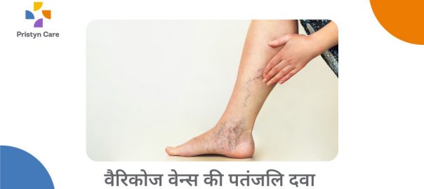 वैरिकोज वेन्स की पतंजलि दवा 