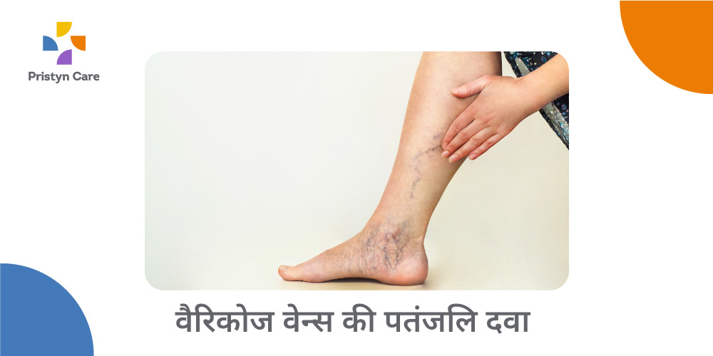 varicose-veins-treatment-in-patanjali-in-hindi