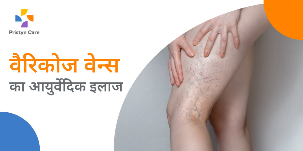 ayurvedic-treatment-of-varicose-veins-in-hindi