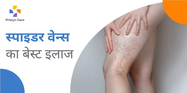 best-treatment-of-spider-veins-in-hindi