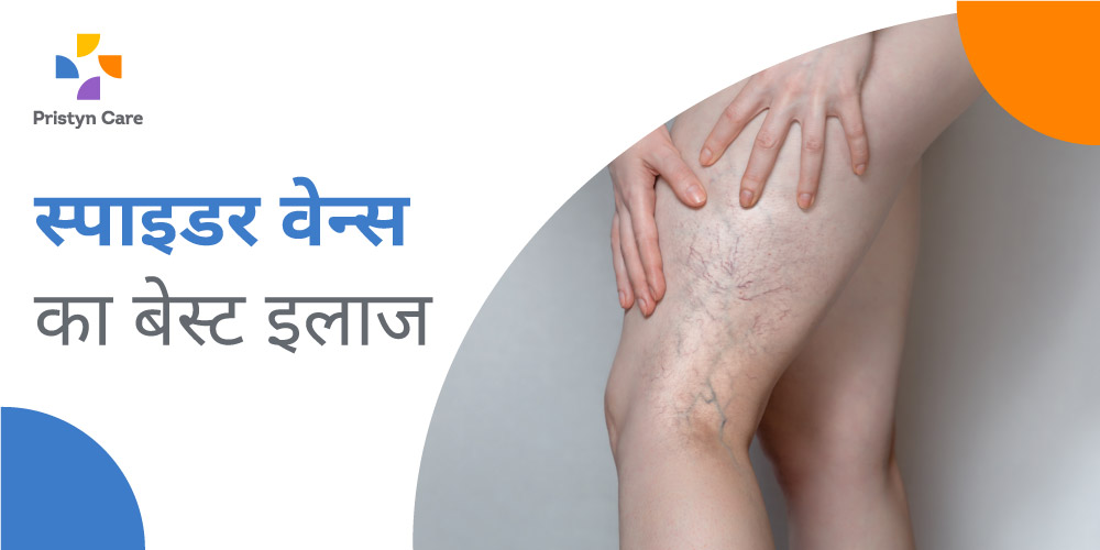 best-treatment-of-spider-veins-in-hindi