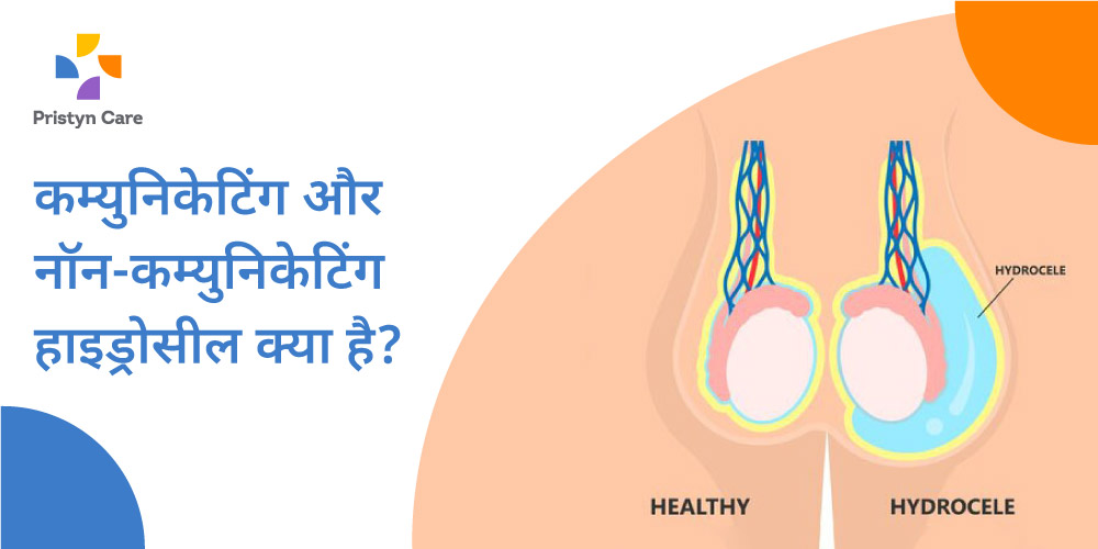 हाइड्रोसील के दो प्रकार और उनमें विषमताएं