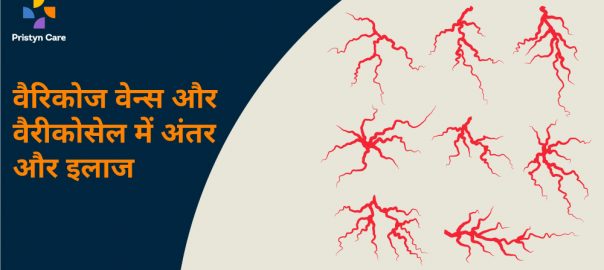 वैरिकोज वेन्स और वैरीकोसेल में अंतर और इलाज