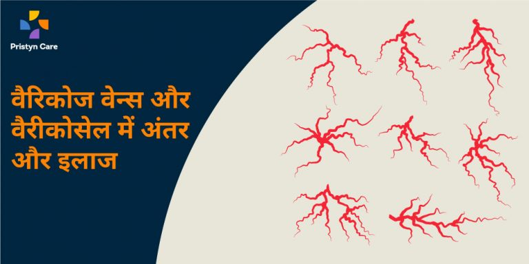 difference-between-varicose-veins-and-varicocele-in-hindi