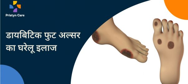 डायबिटिक फुट अल्सर का घरेलू इलाज — Home Remedies For Diabetic Foot Ulcer In Hindi