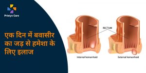 लेजर सर्जरी से बवासीर का एक दिन में इलाज