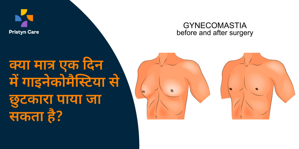 treatment-of-gynaecomastia-in-one-day-in-hindi