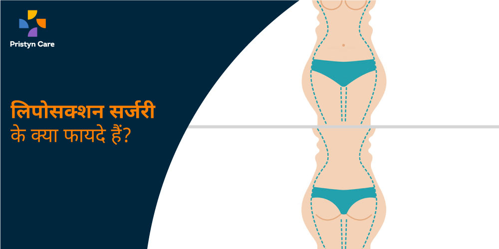 benefits-of-liposuction-surgery-in-hindi