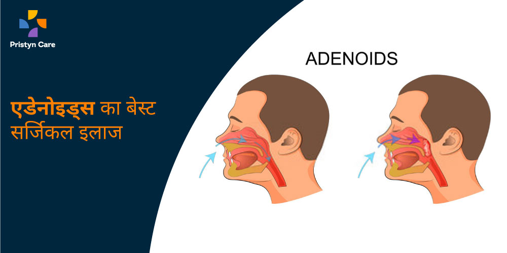 best-surgical-treatment-of-adenoids-in-hindi