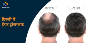 delhi-me-hair-transplant