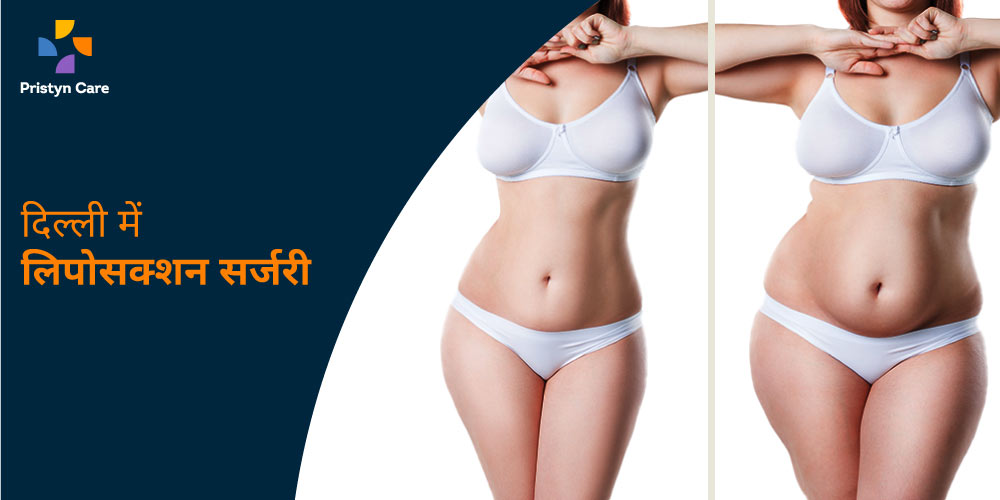 delhi-me-liposuction-surgery