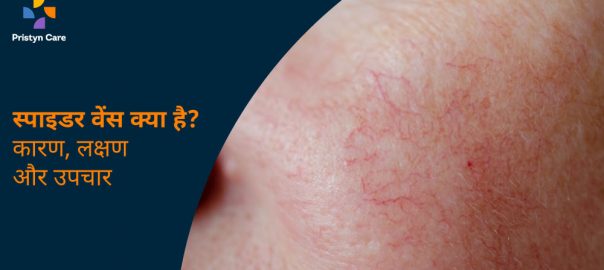स्पाइडर वेंस क्या है? – कारण, लक्षण और उपचार | Spider Veins In Hindi