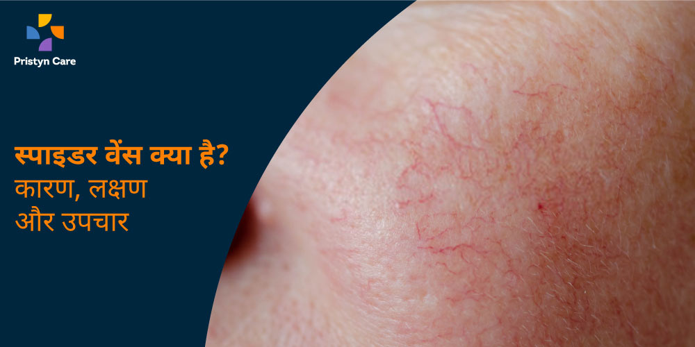 spider veins in hindi