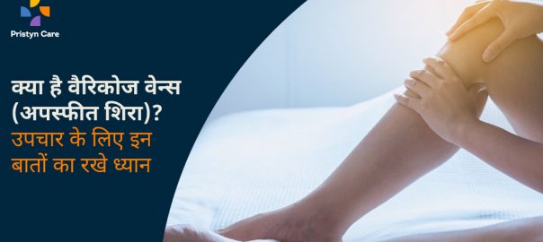 क्या है वैरिकोज वेन्स (अपस्फीत शिरा) — उपचार के लिए इन बातों का रखे ध्यान