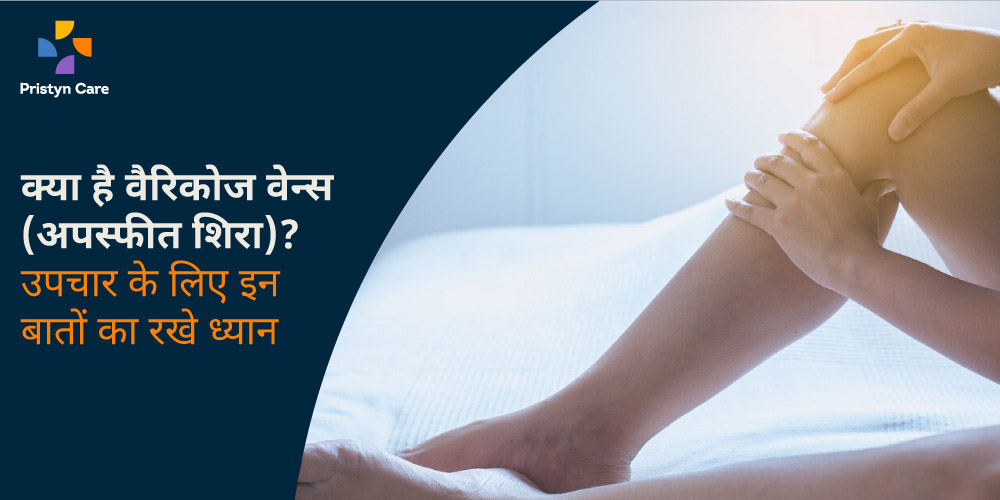 varicose-veins-kya-hai-upchar-ke-liye-in-bato-ka-rakhe-dhyan