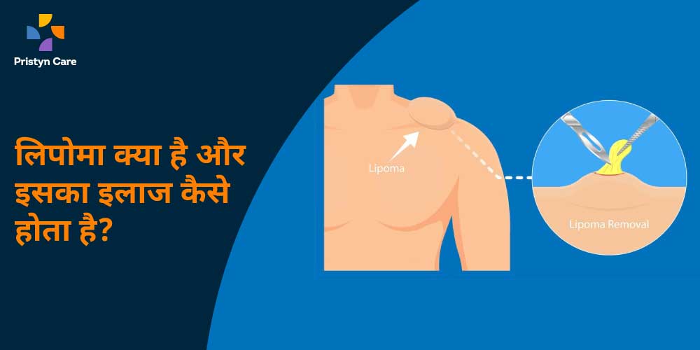 Matted Lymph Nodes कय हत ह  Lymphadenopathy  TB  DrEducation Hindi   YouTube