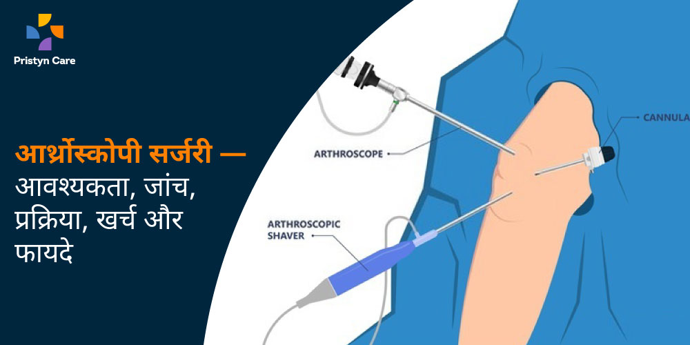 arthroscopy-surgery-ki-jarurat-prakriya-kharch-aur-faayde