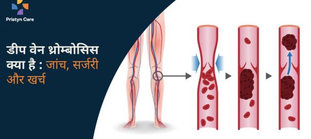 डीप वेन थ्रोम्बोसिस क्या है — जांच, प्रक्रिया और खर्च 