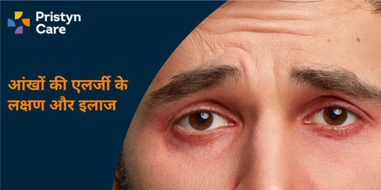 आंखों-की-एलर्जी-के-लक्षण-और-इलाज