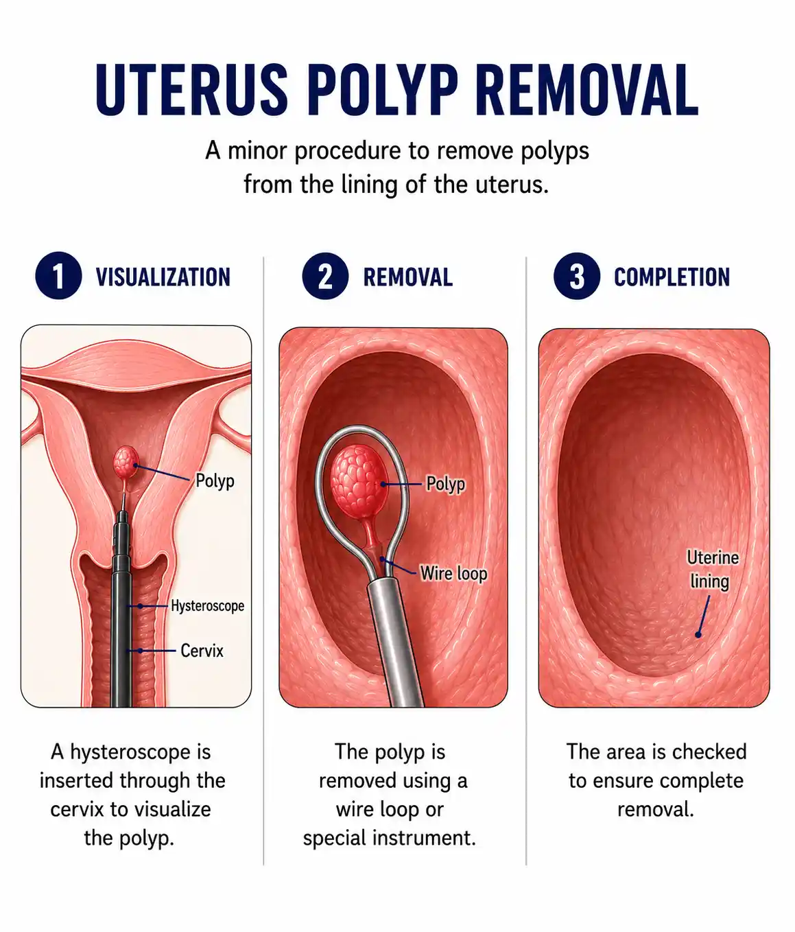 uterus-polyp-removal