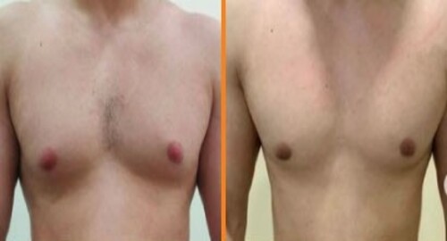 gynecomastia patient 1