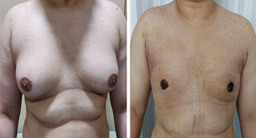gynecomastia patient 2