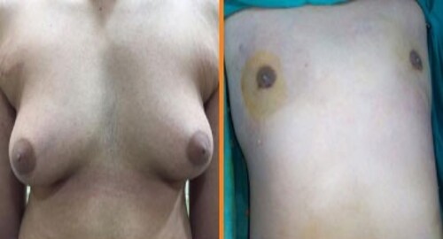 gynecomastia patient 3