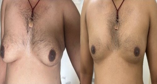 Gynecomastia surgery patient-1