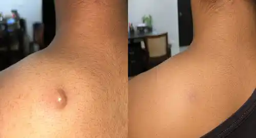 lipoma surgery before after patient-1
