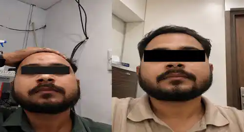 lipoma surgery before after patient-2