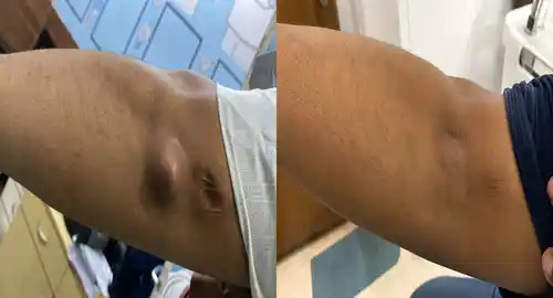 lipoma surgery before after patient-4