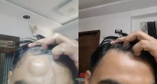 lipoma surgery before after patient-5