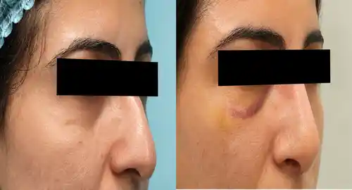 Rhinoplasty Patient 1