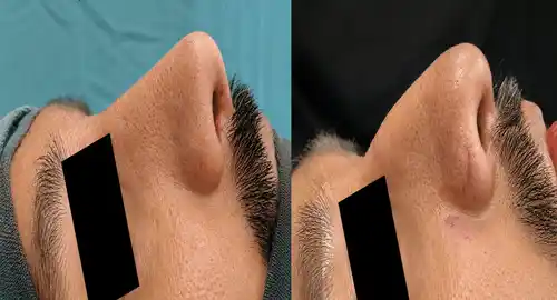 Rhinoplasty Patient 2