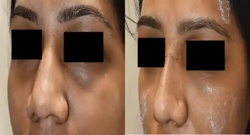 Rhinoplasty Patient 3