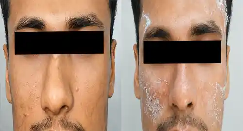 Rhinoplasty Patient 4