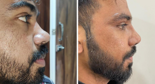 Before and After Images rhinoplasty Patient Undergone Surgery - 2