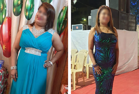 Before and After Image of a Patient undergone Bariatric Surgery - 5