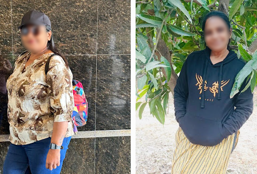 Before and After Image of a Patient undergone Bariatric Surgery - 1